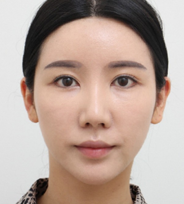 顔の脂肪吸引