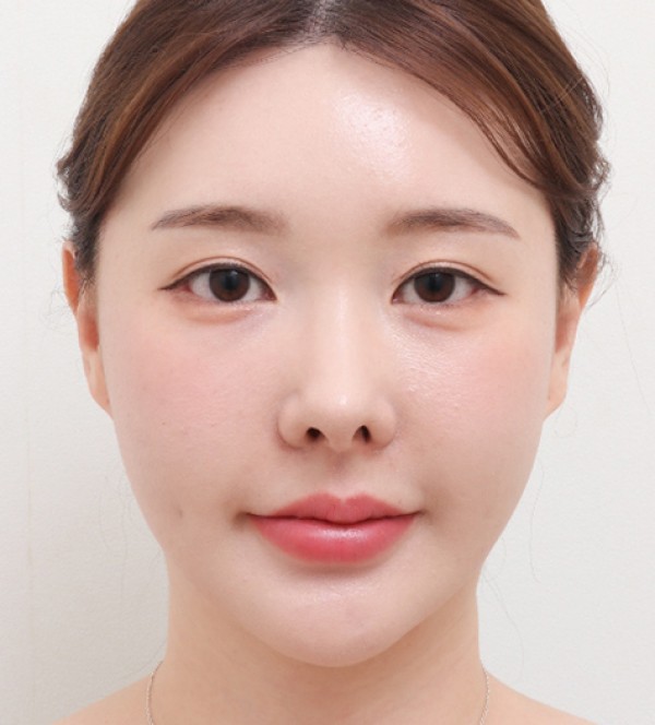 シニア顔脂肪吸引