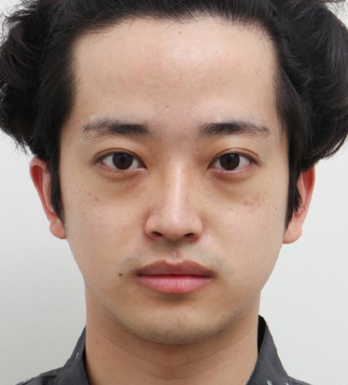 顔の脂肪注入