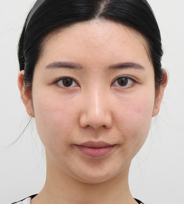 顔の脂肪吸引