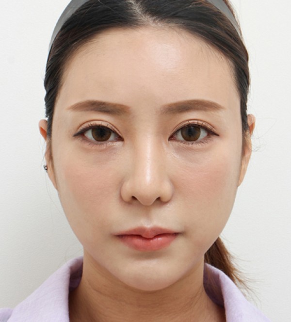顔の脂肪吸引