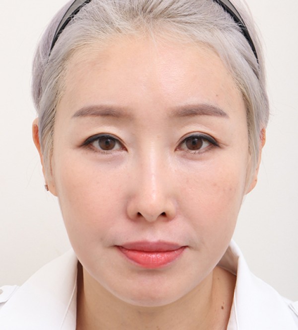 シニア顔脂肪吸引