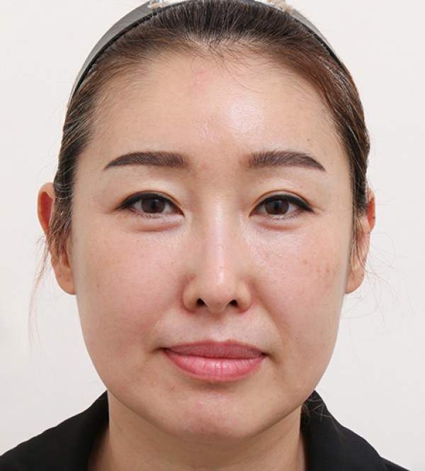 シニア顔脂肪吸引