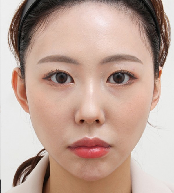 顔の脂肪吸引