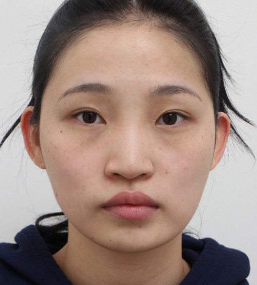 顔の脂肪注入