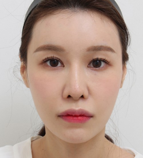 顔の脂肪注入