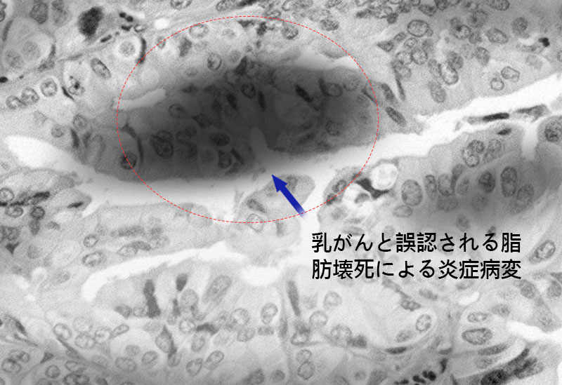 石灰化、脂肪嚢胞の副作用治療