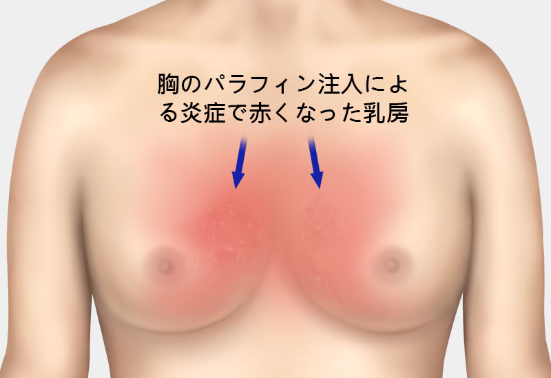 石灰化、脂肪嚢胞の副作用治療