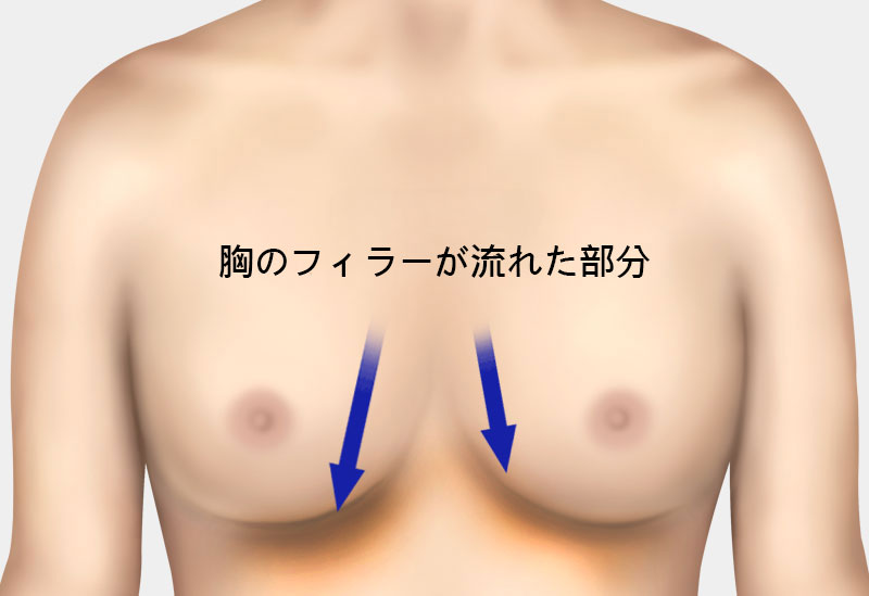 石灰化、脂肪嚢胞の副作用治療