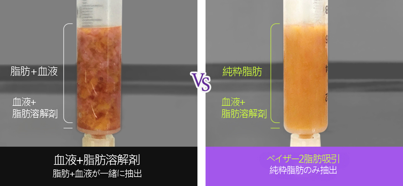 シニアボディ脂肪吸引