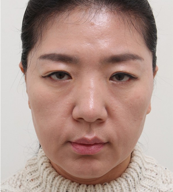 シニア脂肪注入