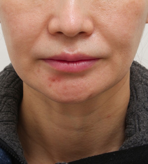 シニア首リフト