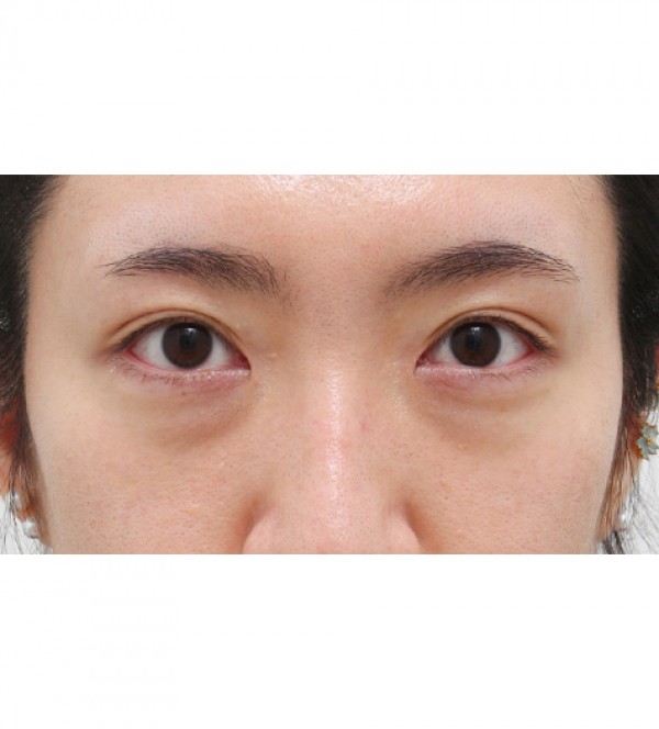 レーザー裏ハムラ…