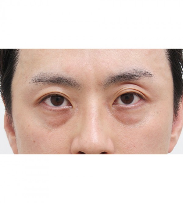 レーザー裏ハムラ…