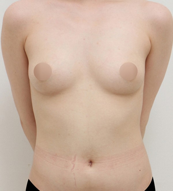 シニア豊胸手術