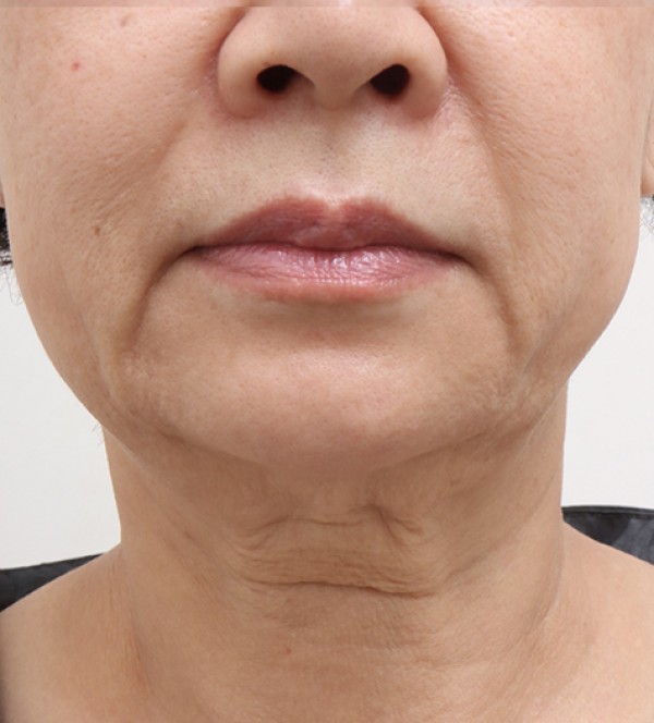 シニア首リフト