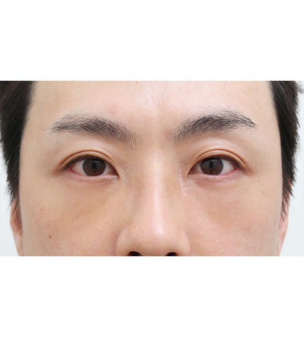 レーザー裏ハムラ…