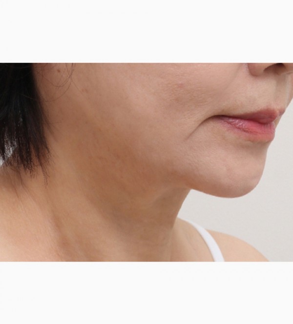 シニア首リフト