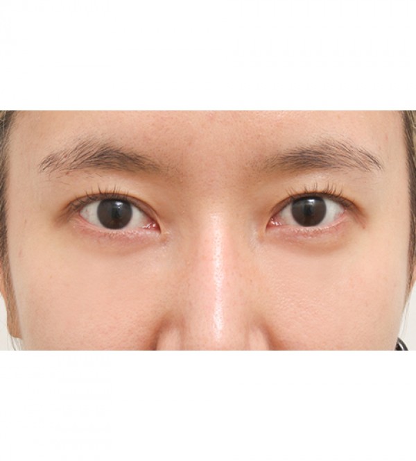 レーザー裏ハムラ…