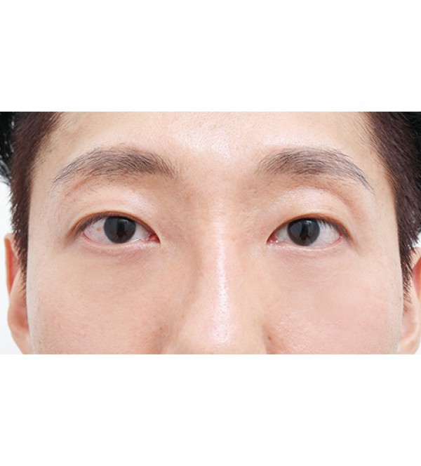 レーザー裏ハムラ…