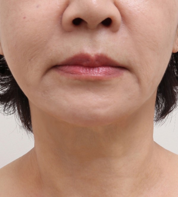 シニア首リフト