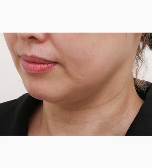 シニア首リフト