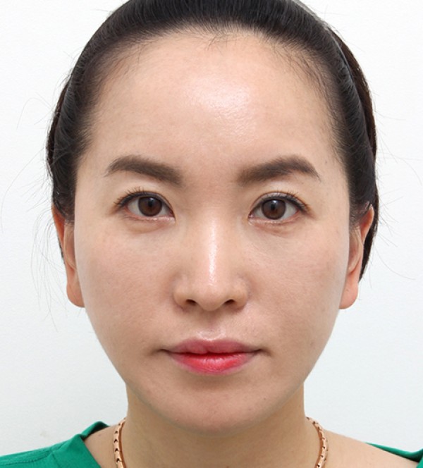 シニア脂肪注入