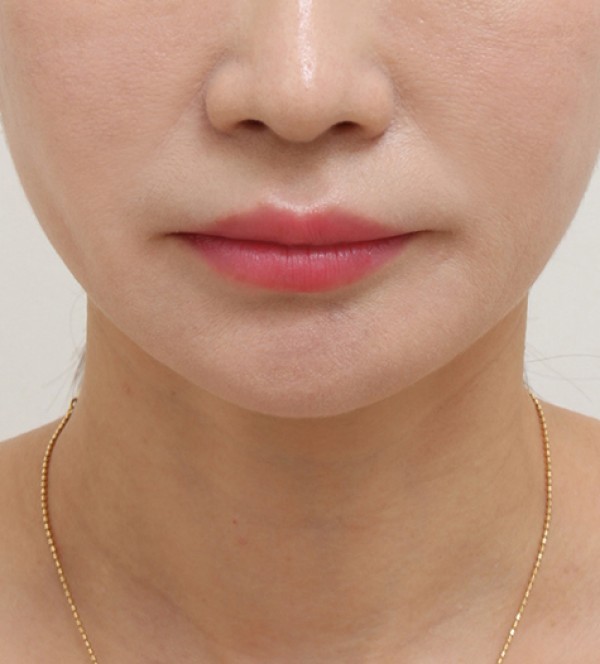 シニア首リフト