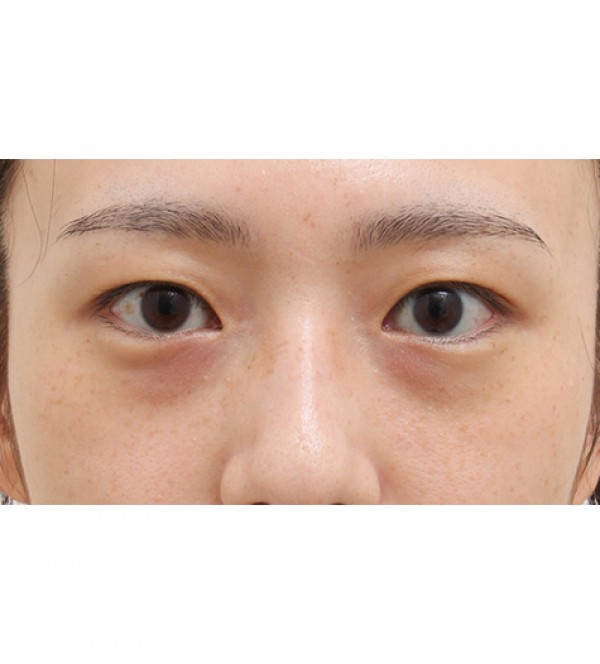 レーザー裏ハムラ…