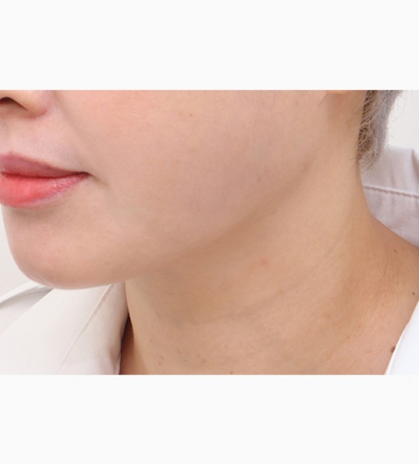 シニア首リフト