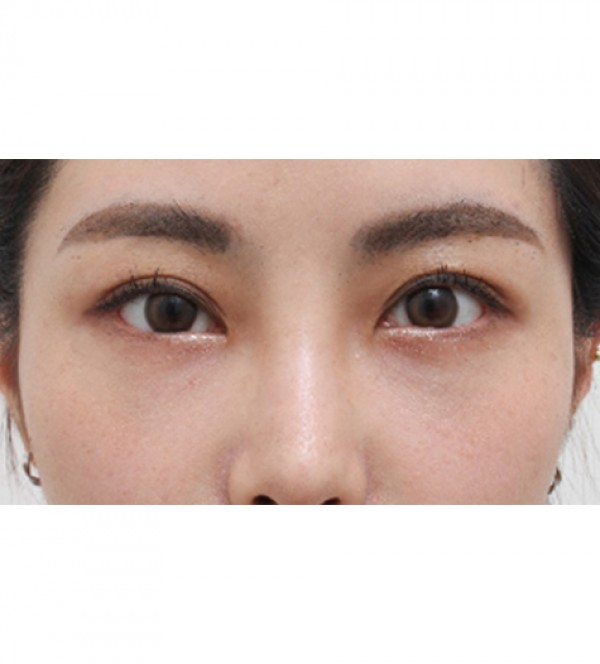 レーザー目の下の…