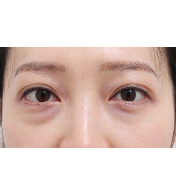 レーザー目の下の…