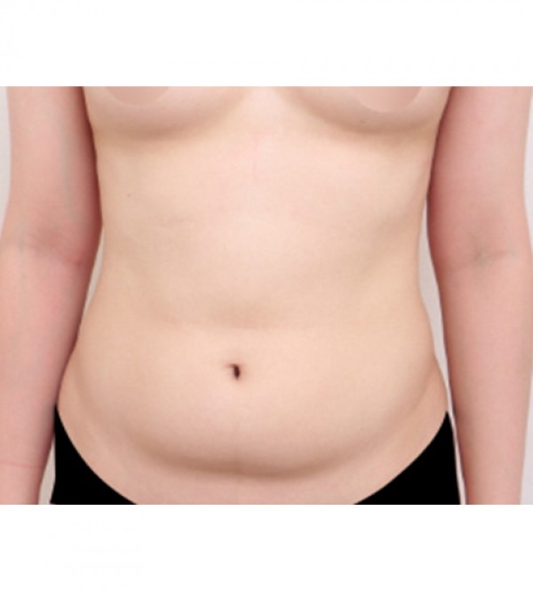 ベイザー2ボディ…