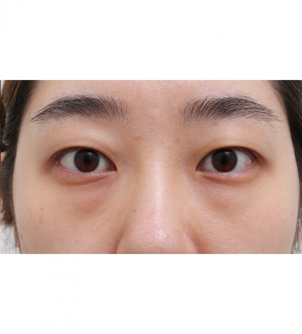 レーザー目の下の…