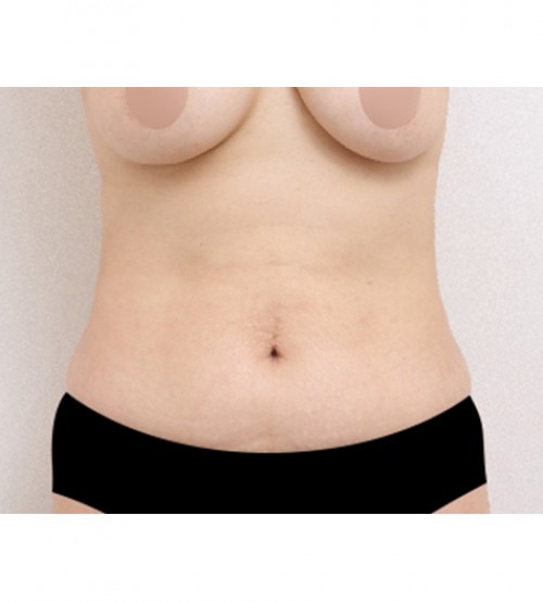 ベイザー2ボディ脂肪吸引