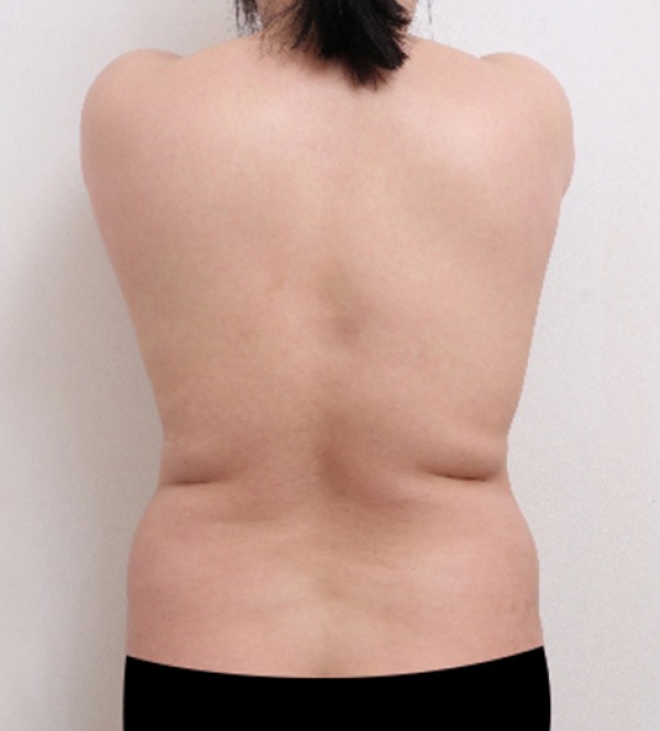 ベイザー2ボディ…