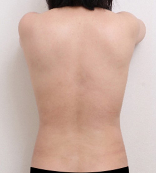 ベイザー2ボディ脂肪吸引