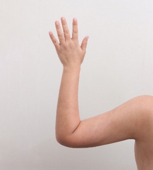 ベイザー2ボディ脂肪吸引