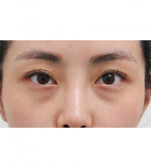 レーザー目の下の脂肪再配置