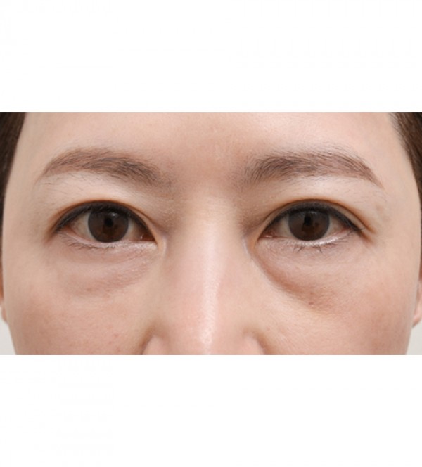 レーザー目の下の…