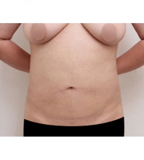 ベイザー2ボディ脂肪吸引