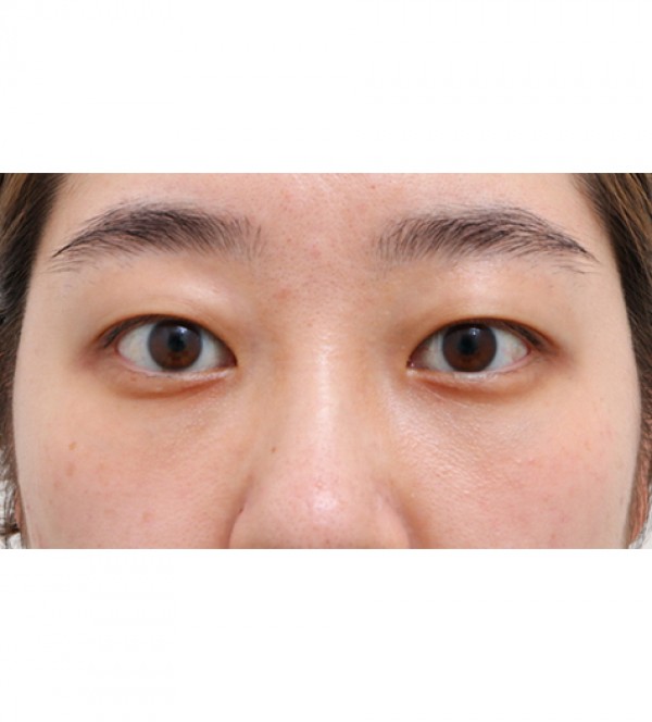 レーザー目の下の…