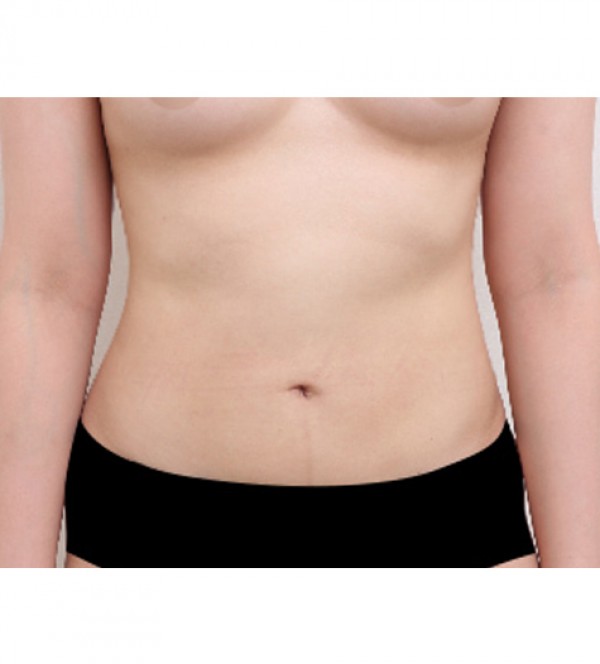 ベイザー2ボディ…