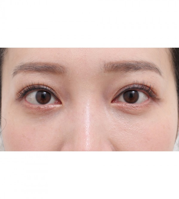 レーザー目の下の…