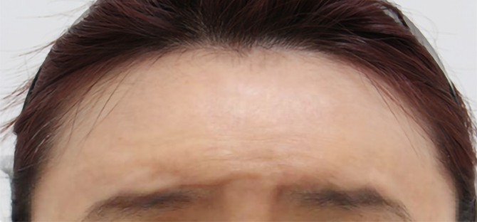 脂肪過剰注入、異物除去