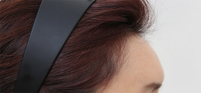 脂肪過剰注入、異物除去