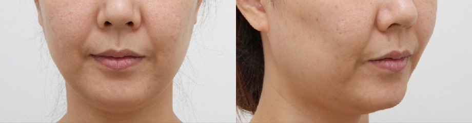 脂肪過剰注入、異物除去