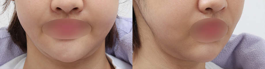 脂肪過剰注入、異物除去