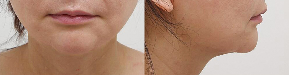 脂肪過剰注入、異物除去