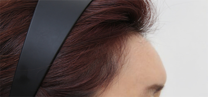 脂肪過剰注入、異物除去